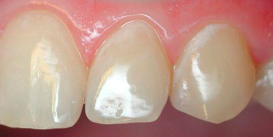 Ne kiekvienas žmogus, radęs tokias baltas dėmeles ant dantų, supras, kad tai yra ėduonis