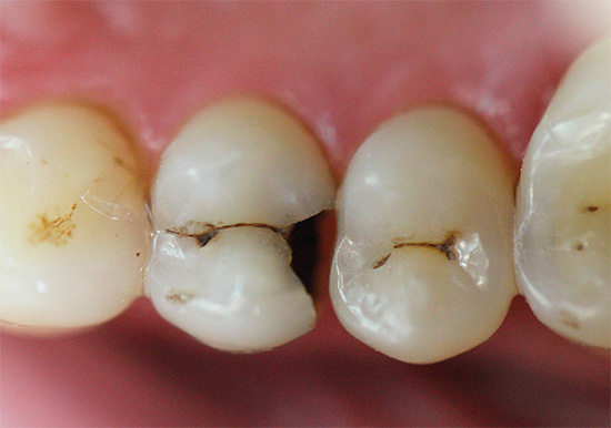 Sıradan bir insanın, dişlerin çeşitli etkilerden acı çekmeye başladığı zaman, çok gelişmiş bir çürüğü teşhis etmesi çok daha kolaydır.
