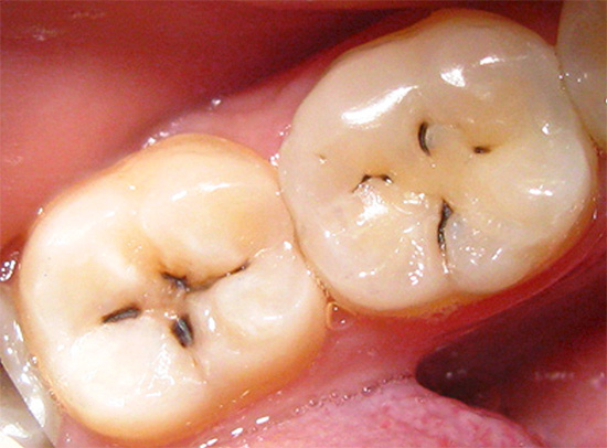 Ett exempel på visuellt tydligt urskiljande karies i form av mörka fläckar och ränder i tandens sprickområde.
