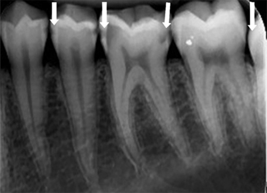 На примеру овог рендгенског снимка зуба јасно се виде тамне мрље које одговарају интерденталном каријесу.