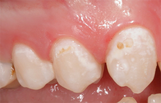 Med innledende karies i fasen av en hvit og til og med sterkt pigmentert flekk, kan tannbehandling ofte utføres med konservative metoder, det er bare viktig å starte i tide ...
