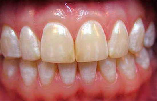 Višestruke bjelkaste mrlje, simetrično smještene na istoimenim zubima, karakteristične su za fluorozu.