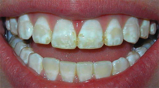 อีกตัวอย่างหนึ่งของการเคลือบฟันด่างที่เกิดจากการฟลูออโรซิส