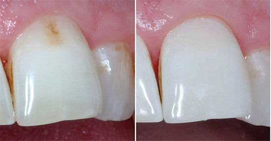 Initial caries in the spot stage can often be cured without the use of a drill.