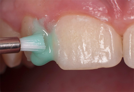 Um die Struktur des Zahnschmelzes wiederherzustellen, wird er mit Verbindungen aus Kalzium, Phosphor und Fluor behandelt.