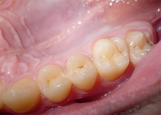 With the right approach, initial caries can be stopped at home.