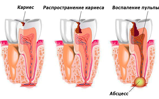 Gambar menunjukkan penyebaran karies jauh ke dalam gigi, diikuti oleh keradangan di akar