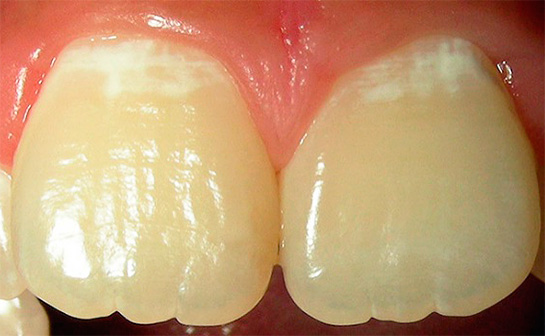Here is another example of initial caries on the front teeth