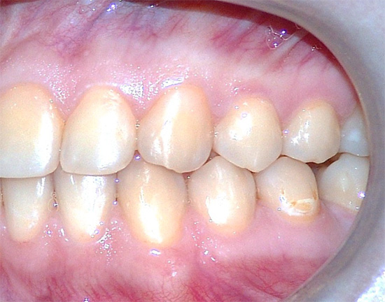 Tento proces může začít na jakémkoli zubu a na jakémkoli povrchu