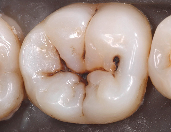 Почетни каријес у фази тамне мрље (пигментиран) у пукотинама зуба