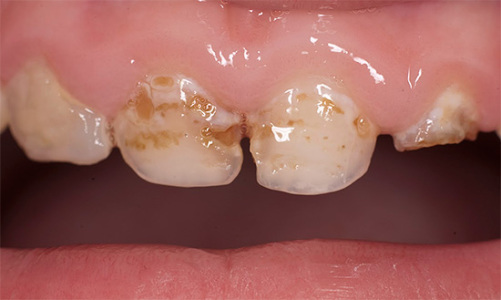 Langfristige Einwirkung von Säuren auf den Zahnschmelz führt zu dessen Demineralisierung und anschließend zu Karies
