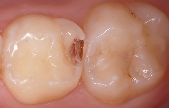 Tilstedeværelsen av kariogene mikroorganismer i munnhulen betyr ikke at tannkarrus vil oppstå