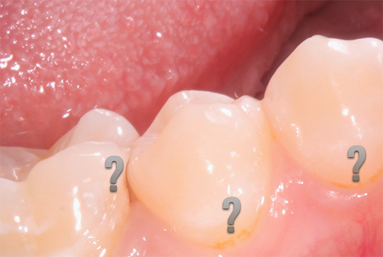 Hablemos de las características de la caries dental oculta, cómo puede verse y qué es potencialmente peligroso ...