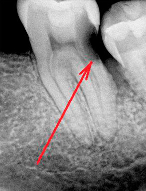 An example of latent caries in the interdental region
