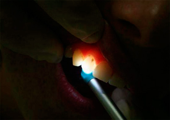 Die Durchleuchtung als Methode zur Diagnose latenter Karies besteht darin, den Zahn mit hellem Licht zu beleuchten, während kariöse Zonen aufgrund ihrer geringeren Transparenz leicht erkannt werden können.