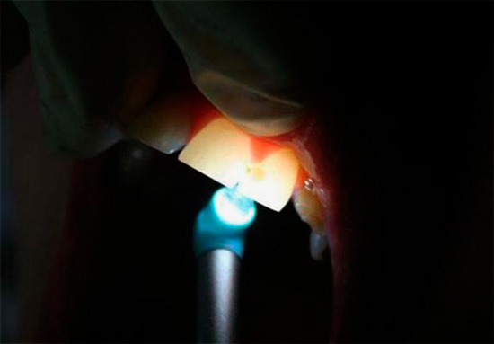 Când dintele este iluminat, zona afectată de carii devine clar vizibilă.