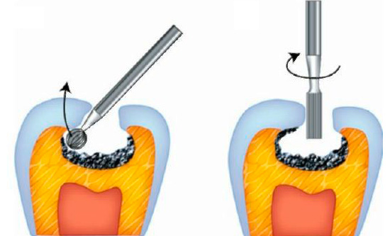 Een voorbeeld van de voorbereiding van holtes in het fissuurgebied van de tand