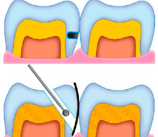 وهنا يعد التحضير الرئيسي لتجويف مسخور خفي مع تسوس بين الأسنان