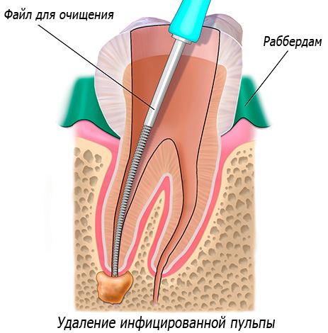 Nuotraukoje schematiškai parodytas dantų kanalų valymas