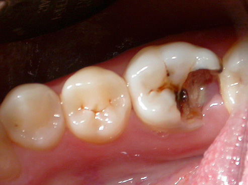Изглежда като зъб, разпад от кариес преди лечението