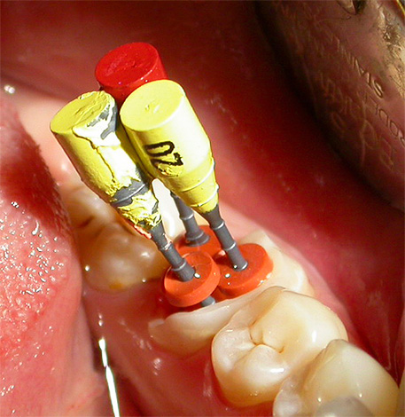 È importante pulire e antisettico completamente ogni canale del dente