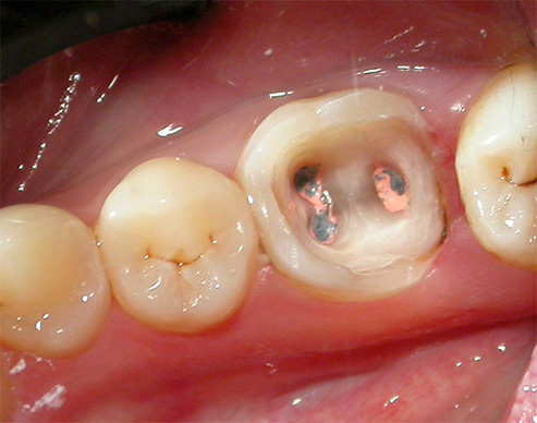 Tas ir tas, kā zobs izskatās pēc depulācijas procedūras, bet ar celma cilni joprojām nav iestatīts.