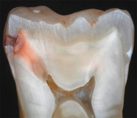 De foto toont een voorbeeld van hoe verborgen cariës eruit zien op een snee van een echte tand: voorheen was het carieuze gebied verborgen op het contactpunt van naburige tanden en gaf het niets uit.