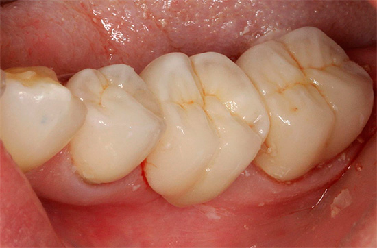 Zubný kaz v puklinovej oblasti môže vyzerať celkom neškodne, ale niekedy sa pod ňou skrývajú rozsiahle kazivé dutiny.