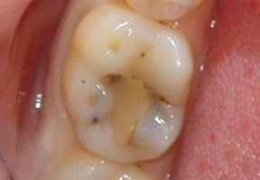 ตัวอย่างของโรคฟันผุที่ซ่อนอยู่ภายใต้การเติม
