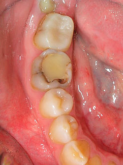 Der kariöse Prozess kann sich sowohl unter der Füllung als auch an der Grenze seiner Passform zum Zahn entwickeln