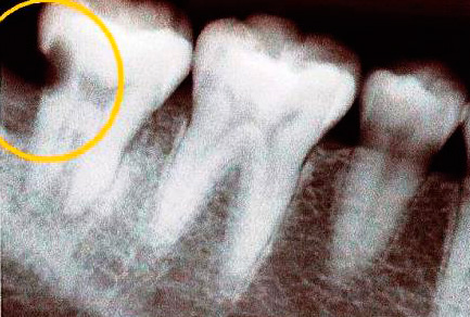 Uz rentgenogrammas ir skaidri redzams kariozs dobums zobā.