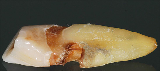 Foto menunjukkan contoh apabila karies tersembunyi di kawasan akar gigi akhirnya menyebabkan keperluan untuk mengeluarkannya.