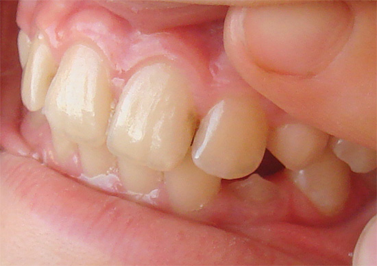 The carious process in the interdental region can capture both teeth at once.