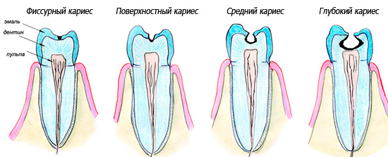 Negydant, progresuoja kariozinis procesas, užfiksuodamas vis gilesnius danties audinius