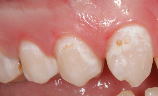 White areas are demineralized enamels that have already partially lost their normal protective properties and become porous.