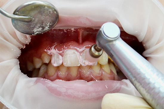 Limpieza mecánica de los dientes antes de ser tratados con agente remineralizante.