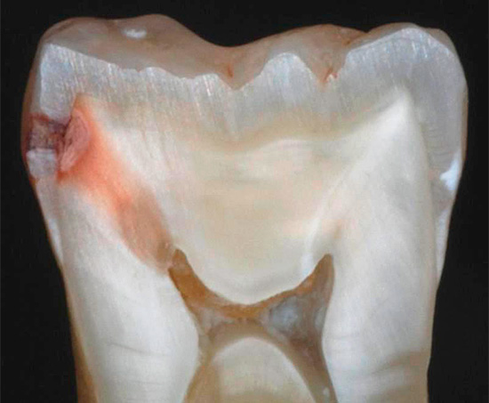 Hvis behandlingen ikke startes i tide, vil karies ødelegge emaljesjiktet og trenge inn i innsiden av tannen, til dentinet og deretter inn i massekammeret ...