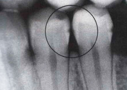 Dantų rentgenogramos pavyzdys - matomas paslėptas tarpdančių kariesas