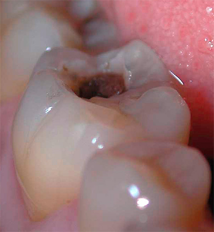 Avec la forme avancée du processus carieux, une dépulpation (ablation du nerf dentaire) peut être nécessaire.