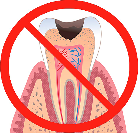 Hoe eerder u naar de tandarts gaat, hoe minder de tand wordt vernietigd en hoe gemakkelijker de behandeling zal zijn.