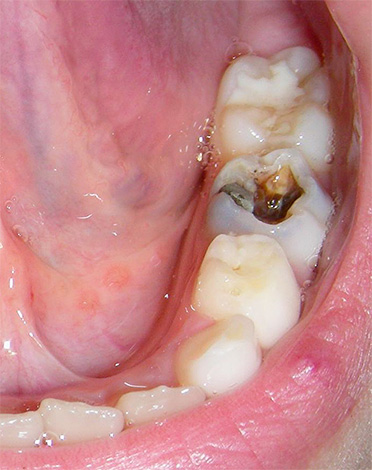 Hlboký kaz s tvorbou rozsiahlej zubnej dutiny, vnútri ktorej je viditeľný pigmentovaný dentín.