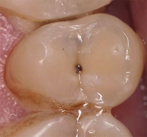 Un autre exemple, lorsque des diagnostics supplémentaires sont nécessaires afin de clarifier s'il y a des caries cachées à l'intérieur de la dent.