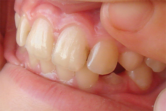 Carious lesion in the interdental space (interdental caries)