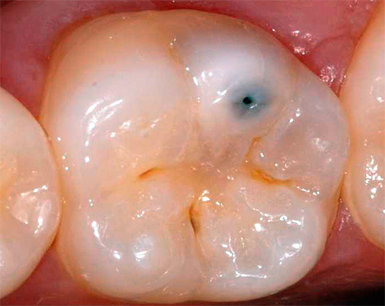 Ibland, med minimala yttre manifestationer, kan kroniska karies leda till gradvis bildning av omfattande karious håligheter i dentinet under emaljen.