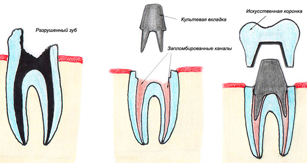 Obrázok ukazuje obnovenie poškodeného zubu pomocou pahýlika a korunky.