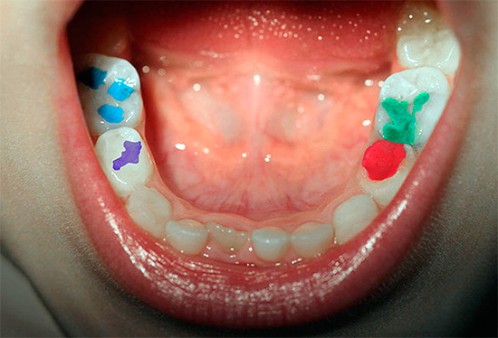 استخدام الحشوات الملونة يجعل علاج الأسنان يشبه اللعبة ، ونتيجة لذلك يصبح الإجراء بأكمله أقل مخيفًا للطفل.
