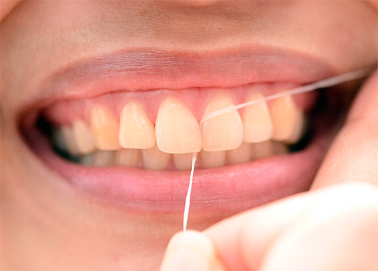 Bruk av tanntråd lar deg effektivt rengjøre interdentalrommene, der karies også kan utvikle seg skjult.
