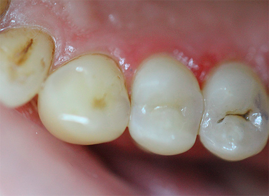 Sovint es prenen rastres de càries dental a les dents.