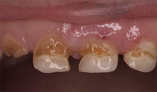 Les caries chroniques, en particulier sur les dents de lait, peuvent facilement prendre une forme aiguë, caractérisée par une destruction très rapide de l'émail et de la dentine.