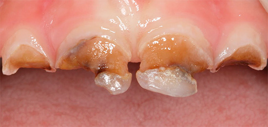 La foto mostra un esempio di denti decidui, quasi completamente distrutti da un acuto processo cariato.